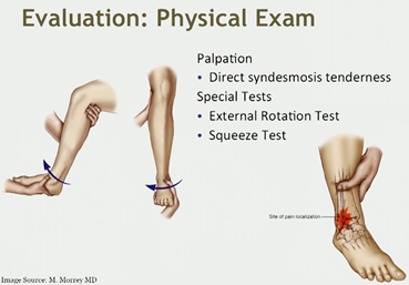 Ankle Syndesmosis Injuries