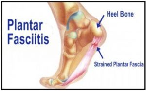 Plantar Fasciitis