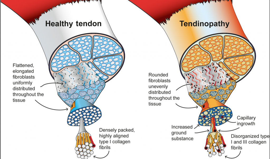 How to Rehabilitate a Tendinopathy Phase 1 (Reducing symptoms & pain