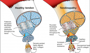 Tendinopathy