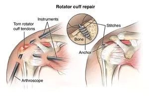 Rotator Tear