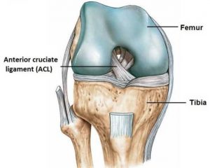 Ruptured ACL