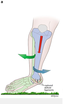 Ankle Syndesmosis Injuries
