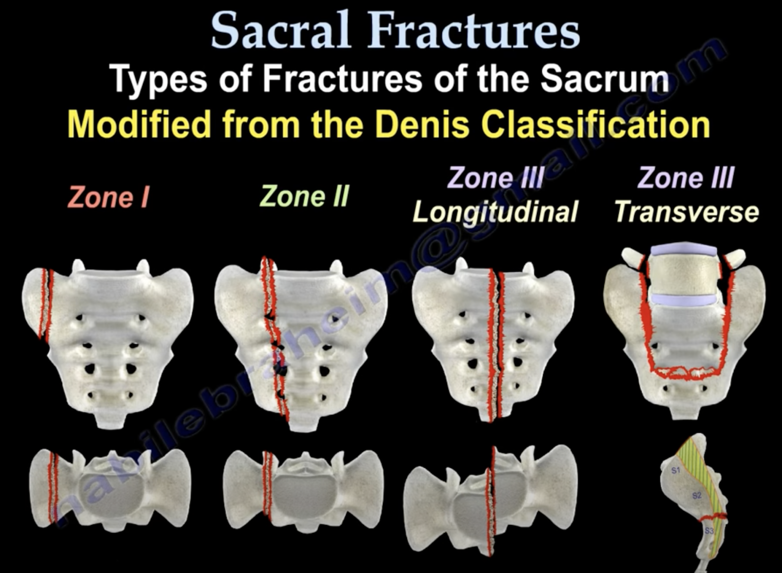 Sacral bone stress injuries in runners POGO Physio Gold Coast