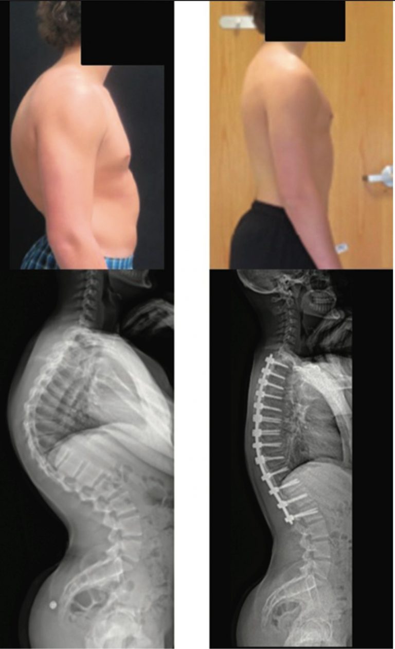 Scheuermann’s Disease | POGO Physio Gold Coast