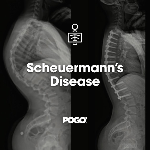 Scheuermanns Disease