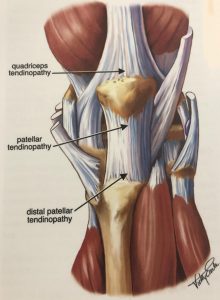 Patellar Tendinopathy 