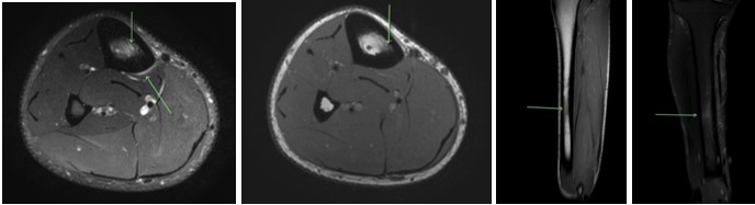Tibial Bone Stress