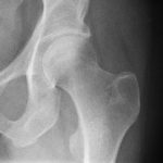 Femoral Head